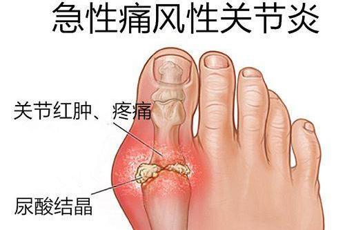 哈佛研究证实：痛风最危险的3个早期信号，千万别忽视