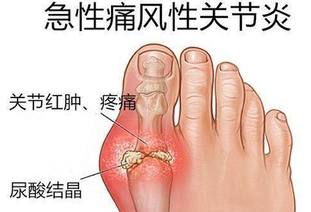哈佛研究证实：痛风最危险的3个早期信号，千万别忽视